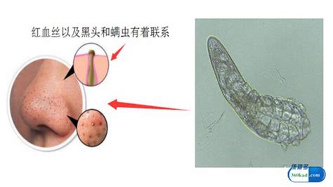 鼻翼有血絲|鼻子兩側有紅血絲是咋回事？試下這些好方法吧，還你。